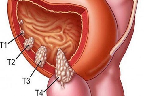 Người đàn ông 57 tuổi phát hiện u bàng quang từ dấu hiệu nhiều người Việt mắc phải nhưng bỏ qua