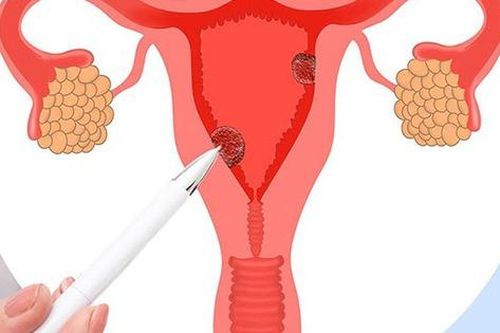 Hội chứng buồng trứng chuyển hóa đa nội tiết - tên gọi mới của hội chứng buồng trứng đa nang