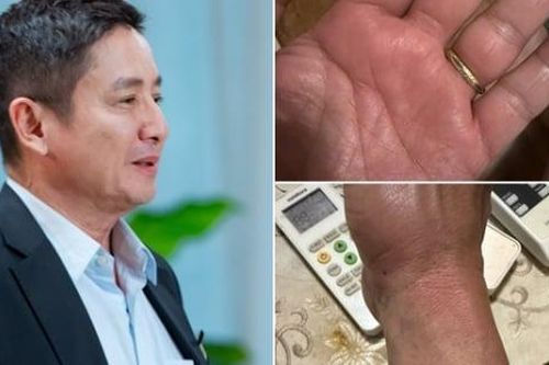 NSƯT Chí Trung khổ sở vì bị ký sinh trùng