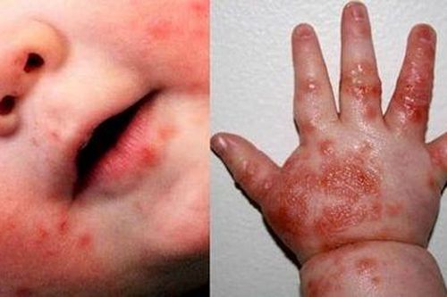 TP. HCM: Sốt xuất huyết tăng hơn 70%, tay chân miệng cũng tăng gấp đôi