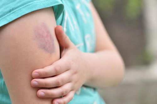Cảnh báo nguy cơ nhiễm trùng máu từ các vết thương nhỏ