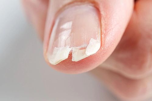 Bất thường ở móng tay cảnh báo bệnh gan, tiểu đường