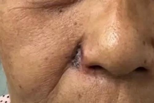 Nốt ruồi đổi màu bất thường, người phụ nữ 'sốc' khi phát hiện căn bệnh này
