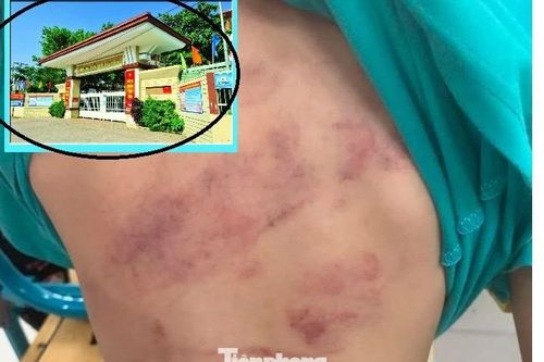 Học sinh lớp 1 bị bạn đánh hội đồng, phụ huynh bức xúc vì con phải chuyển lớp