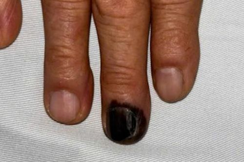 Móng tay bỗng đen sì, người đàn ông 60 tuổi 'sốc' khi phát hiện bệnh cực nguy hiểm