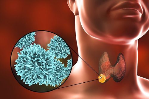 U tuyến giáp: Nhận diện sớm để điều trị hiệu quả