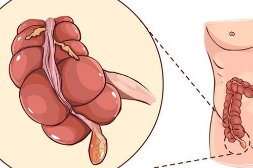 Viêm ruột thừa dễ nhầm lẫn và có thể gây biến chứng gì?
