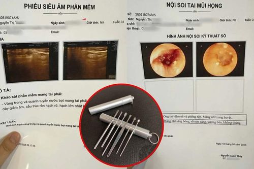 Dùng một loại dụng cụ ngoáy tai quen thuộc, cô gái phải nhập viện điều trị