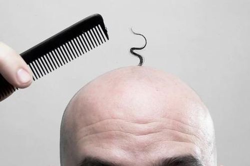 Hé lộ quốc gia có tỉ lệ đàn ông hói đầu cao nhất thế giới, vị trí số 1 gây bất ngờ