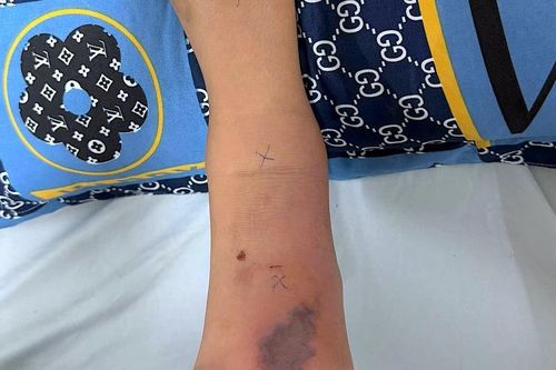 Cứu sống bé trai bị rắn cắn ngưng thở tại Cà Mau