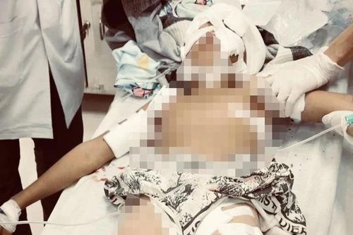 Lại thêm một vụ chó tấn công người, bé trai 11 tuổi phải nhập viện cấp cứu