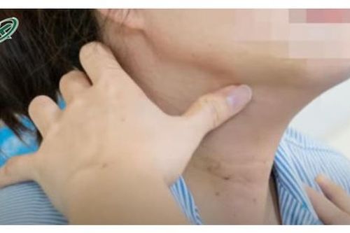 Viêm tuyến giáp mạn tính có làm tăng nguy cơ ung thư tuyến giáp không ?