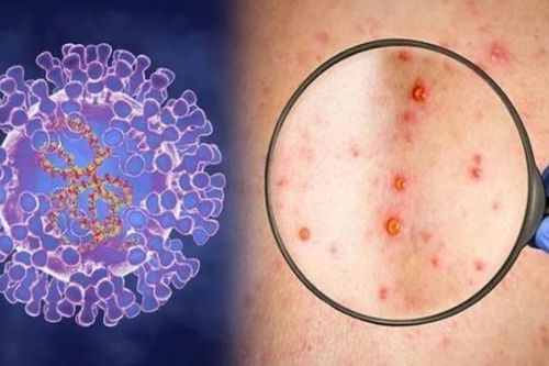 Bộ Y tế hướng dẫn cách phân loại bệnh truyền nhiễm nhóm A, B, C từ ngày 1/7