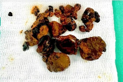 Cứu bệnh nhân nhiễm trùng đường mật nặng do sỏi tái phát sau 2 lần mổ