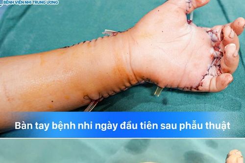 Bé 7 tuổi suýt mất bàn tay vì máy tự chế, hồi chuông cảnh báo trong nhiều gia đình