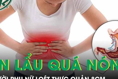 Người phụ nữ loét thực quản 8cm vì thói quen ăn lẩu quá nóng