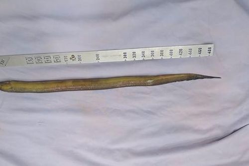 Đau bụng dữ dội, bác sĩ phát hiện con lươn dài hơn 50cm trong ổ bụng người đàn ông