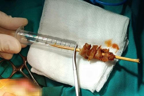 Thành công cứu bé gái bị que xiên thịt đâm xuyên nền sọ