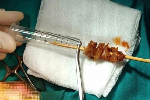 Xuyên đêm cứu bé gái 2,5 tuổi bị que xiên thịt đâm sát não