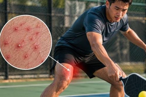 Chơi Pickleball, bóng đá mùa nóng: Nam giới dễ bị nhiễm trùng da
