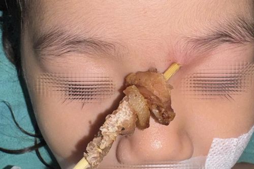 Hy hữu: Bé gái bị que xiên thịt đâm sâu, nguy cơ xuyên sọ não