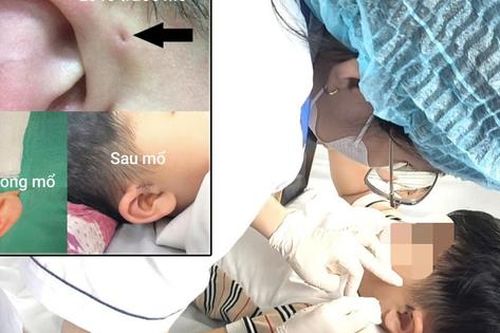 Hi hữu ca rò luân nhĩ di truyền qua 3 thế hệ
