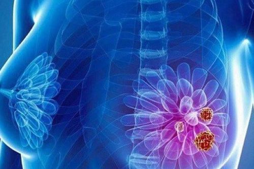 Người phụ nữ phát hiện ung thư vú từ dấu hiệu ít ai ngờ tới