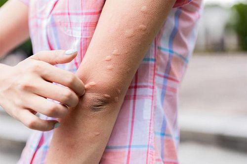 Mề đay dễ bùng phát khi nắng nóng: 3 cách làm giảm ngứa, dịu da