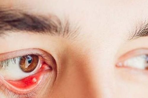 Nguyên nhân gây cộm mắt và cách khắc phục