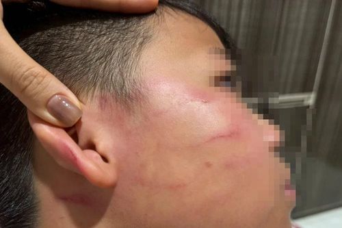Vụ giáo viên nước ngoài tát học sinh: Gia đình nói bé trai bị thủng màng nhĩ