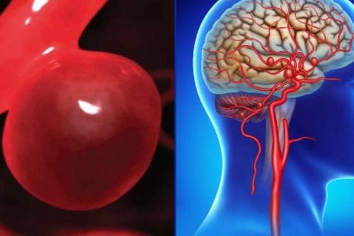 Đau đầu, buồn nôn kéo dài, người phụ nữ 44 tuổi bất ngờ phát hiện phình động mạch não