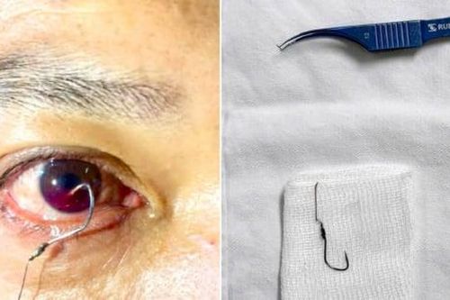 Cấp cứu thành công cho người đàn ông bị lưỡi câu móc vào mắt khi đi câu cá