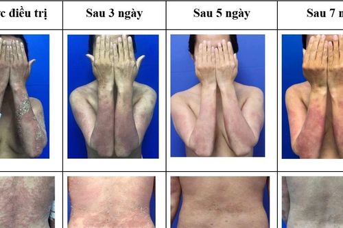 Điều trị thành công ca vảy nến thể mủ toàn thân nặng bằng thuốc sinh học mới
