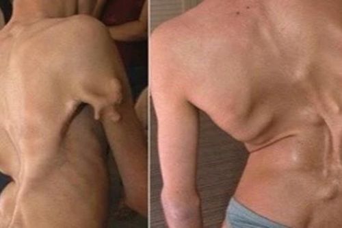 Bé gái 12 tuổi mắc hội chứng 'người hóa đá' cực hiếm, cả triệu người mới có một ca
