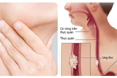 Người đàn ông phát hiện mắc ung thư thực quản thừa nhận 2 sai lầm nhiều người Việt mắc phải