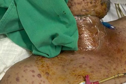 Nam bệnh nhân 32 tuổi bị biến chứng thủy đậu phải thở máy kéo dài