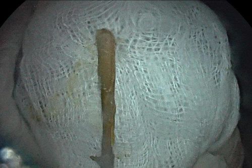Nội soi lấy dị vật đâm thủng đại tràng, cứu bệnh nhân tắc ruột