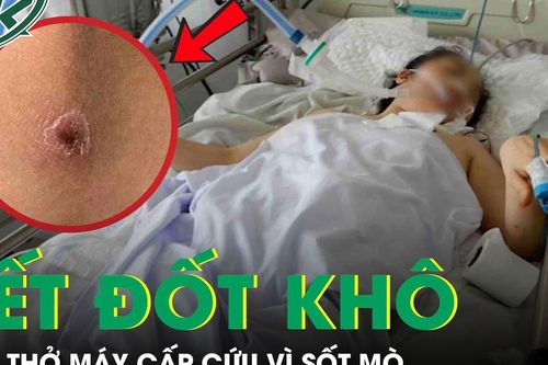 Người phụ nữ 49 tuổi lâm bạo bệnh, phải thở máy cấp cứu chỉ từ một vết đốt khô
