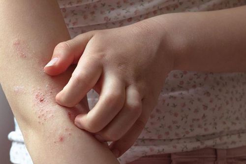 Dấu hiệu ngứa do ký sinh trùng