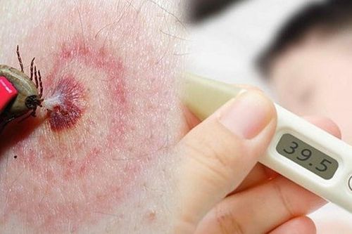 Suy đa tạng do mò đốt, đặc trưng của bệnh sốt mò cần biết
