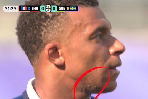 Nốt sần sùi trên mặt Mbappe thu hút gần 60 triệu view