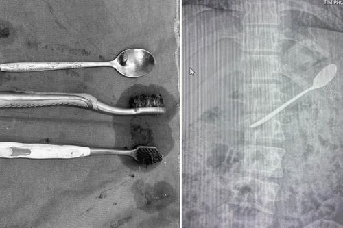 Tìm thấy nhiều bàn chải đánh răng, thìa inox trong dạ dày nam thanh niên Hà Nội