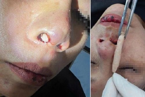 Tai nạn giao thông làm lộ sụn nâng mũi, nữ bệnh nhân nguy cơ nhiễm trùng cao