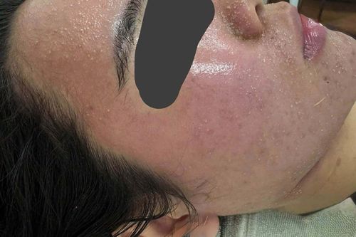 Mặt sưng phù, nổi kín mụn sau vài lần dùng mỹ phẩm dưỡng trắng trên mạng