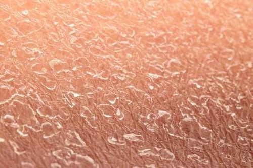 Bệnh hiếm khiến làn da liên tục bong tróc suốt đời