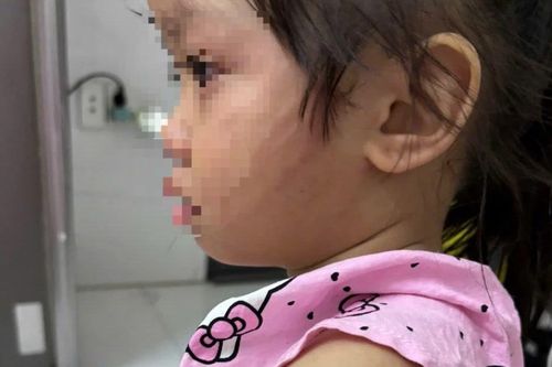 Theo dõi sức khỏe, tâm lý bé gái 3 tuổi bị người tình của mẹ bạo hành