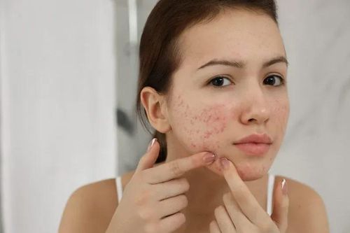 Muốn ngăn mụn tái phát? Đừng bỏ qua 6 bước chăm sóc da quan trọng này