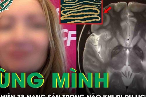 Rùng mình: Cô gái tá hỏa phát hiện 38 nang sán trong não