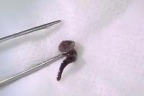 Uống nước ở suối, nam thanh niên bị con đỉa dài 2,5cm chui vào mũi