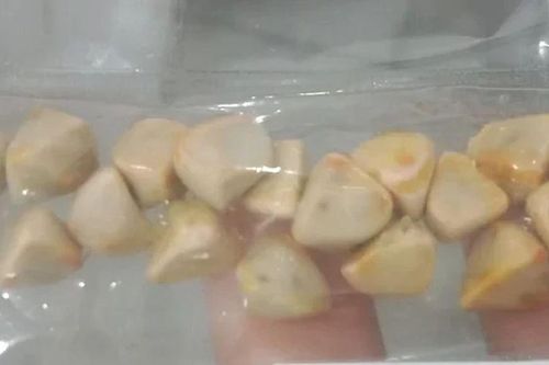 Ngày nào cũng uống trà đá, người phụ nữ đi khám mới bàng hoàng phát hiện cả 'ổ' sỏi trong cơ thể: Bác sĩ cảnh báo điều này